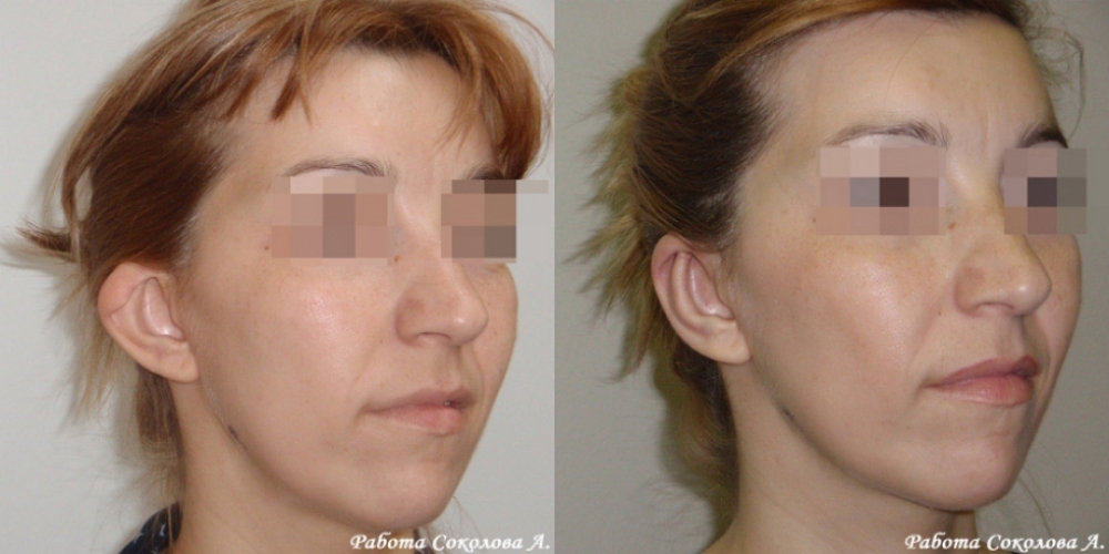 Отопластика с устранением деформации ушной раковины у хирурга Соколова А. А. фото до и после