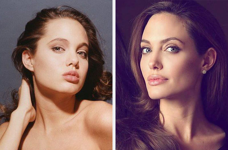 Анджелина Джоли до и после пластики подбородка