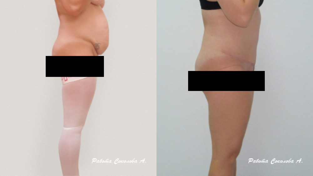 Абдоминопластика с липосакцией верхней части живота и устранением диастаза, фото до и после