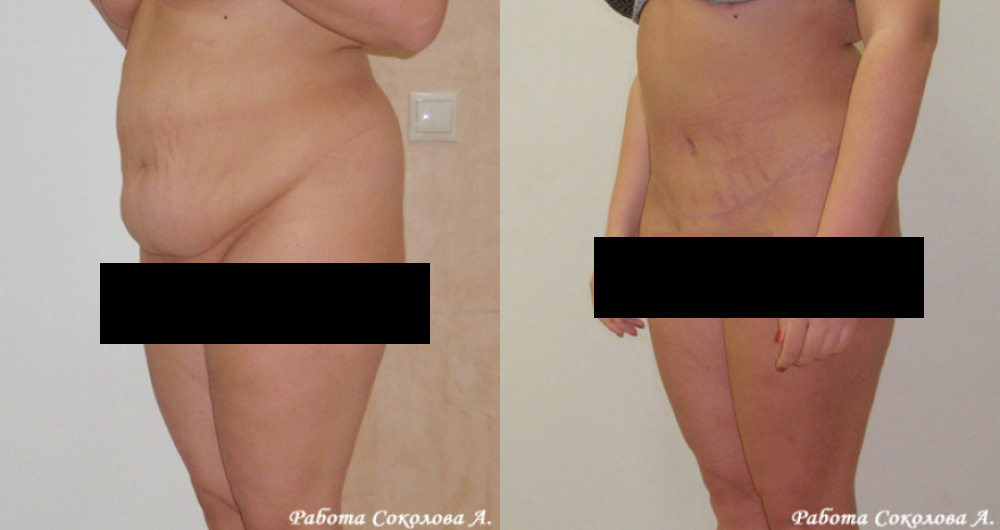 Абдоминопластика с одновременной липосакцией и устранением диастаза, фото до и после