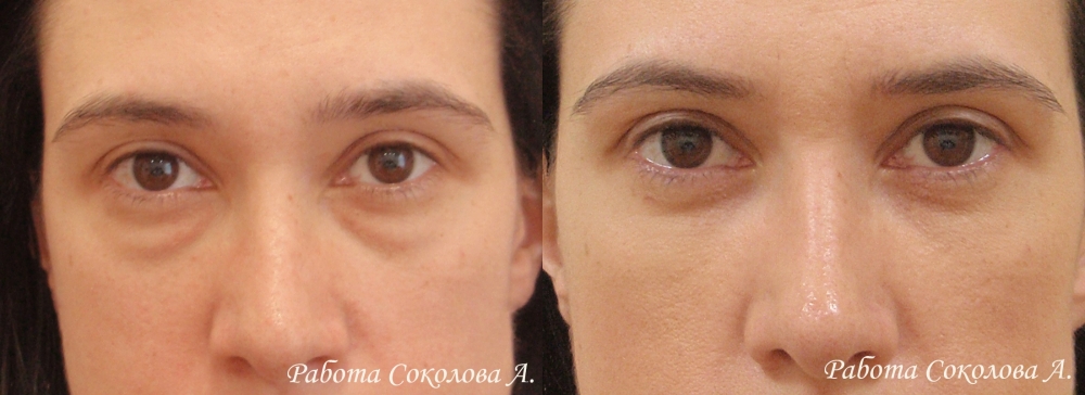 Нижняя трансконьюнктивальная блефаропластика у хирурга Соколова А. А. фото до и после