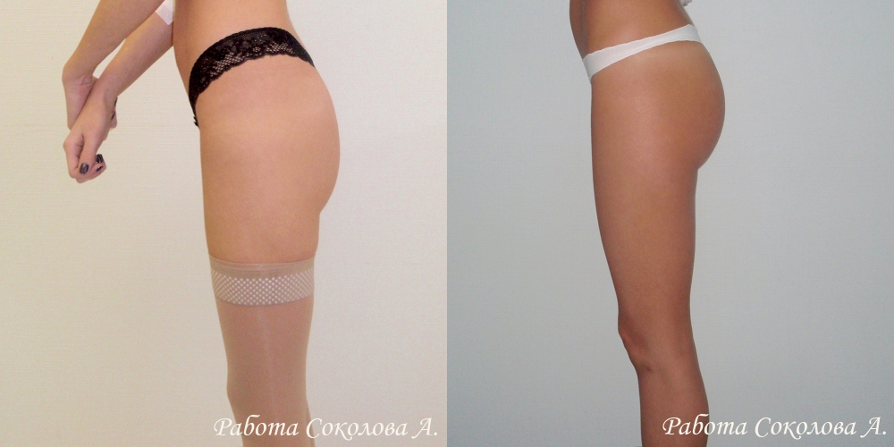 Увеличение ягодиц анатомическими имплантами Евросиликон 150см3 фото до и после