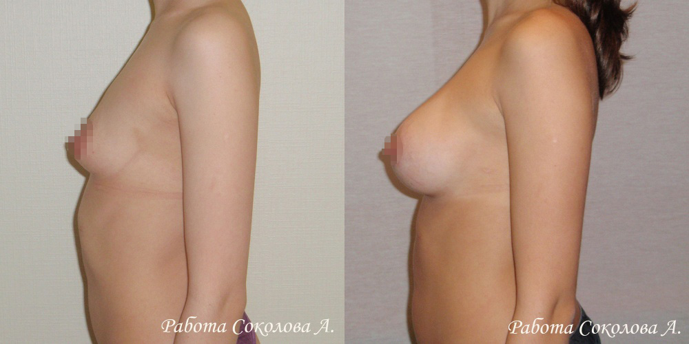 Аугментационная маммопластика через периареолярный доступ, фото до и после