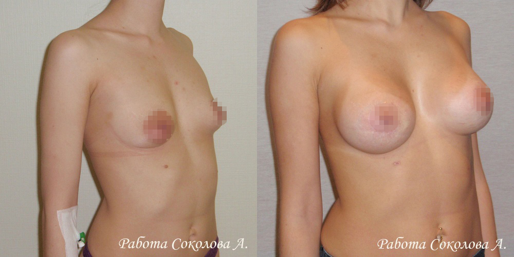Аугментационная маммопластика через периареолярный доступ, фото до и после