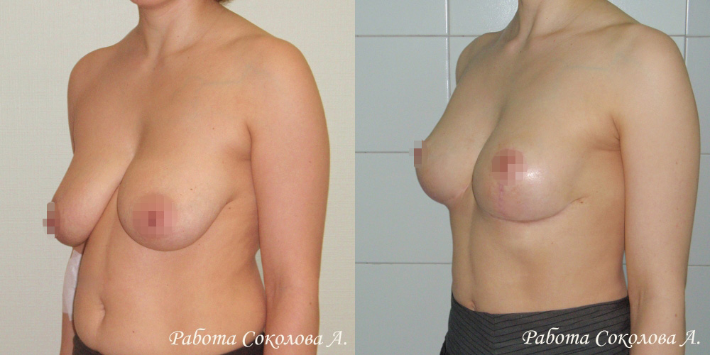 Якорная подтяжка груди у пластического хирурга Соколова А. А., фото до и после