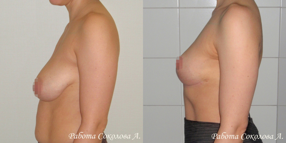 Якорная подтяжка груди у пластического хирурга Соколова А. А., фото до и после