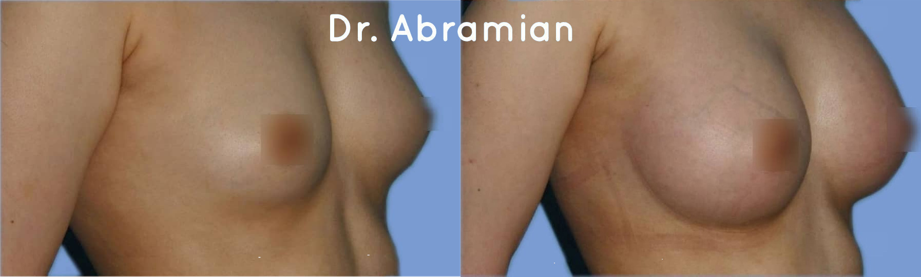 Эндоскопическое увеличение груди имплантами 300 мл, фото до и после