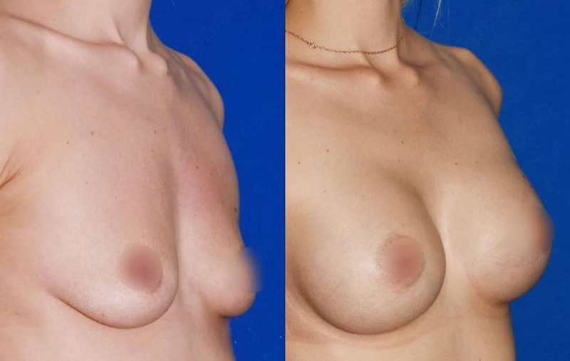 Эндоскопическое увеличение груди у хирурга Абрамяна С. М., фото до и после