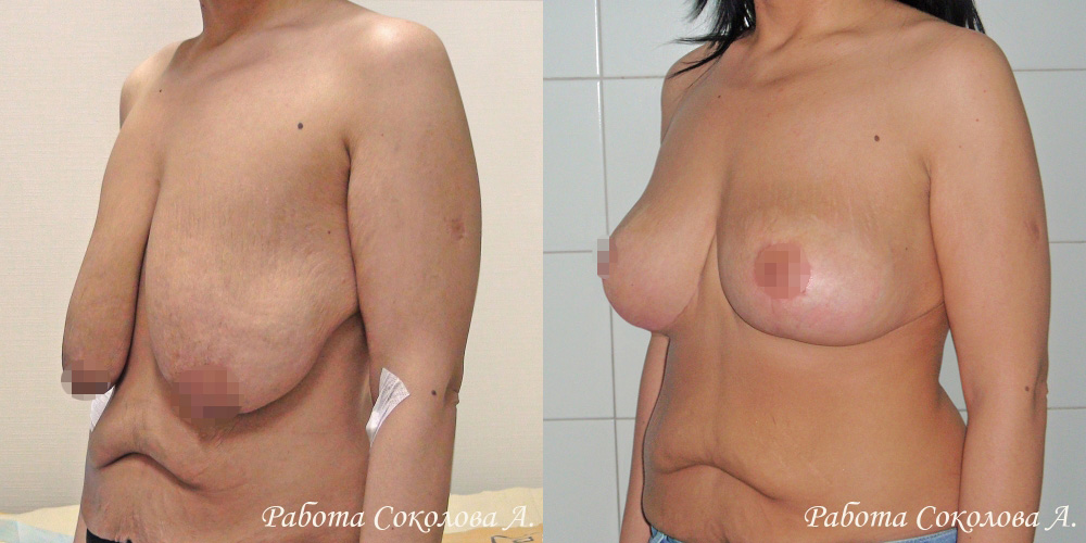 Классическая мастопексия с якорным разрезом при птозе 4 степени, фото до и после