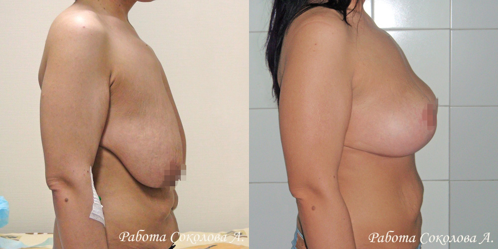 Классическая мастопексия с якорным разрезом при птозе 4 степени, фото до и после