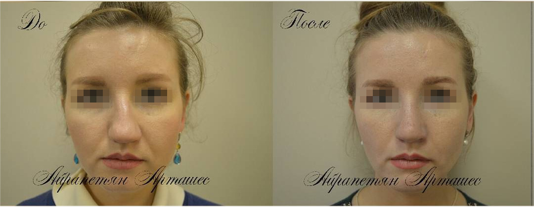 Коррекция посттравматической деформации носа, фото до и после