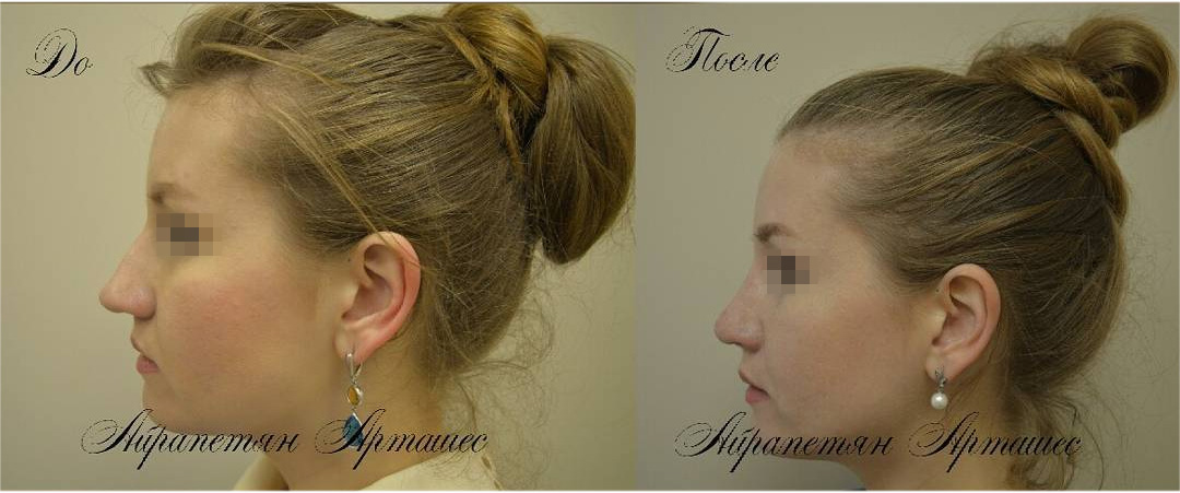 Коррекция посттравматической деформации носа, фото до и после