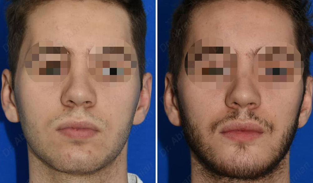 Коррекция профиля с помощью ментопластики, фото до и после