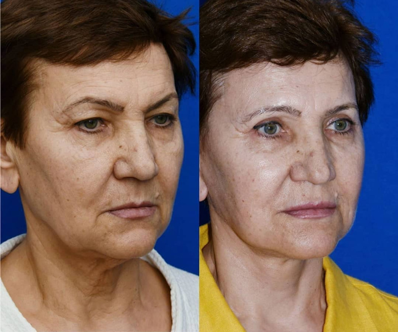 Подтяжка лица и круговая блефаропластика, фото до и после