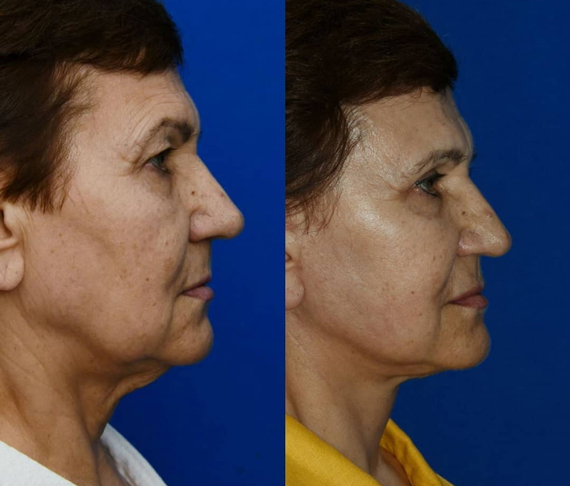 Подтяжка лица и круговая блефаропластика, фото до и после