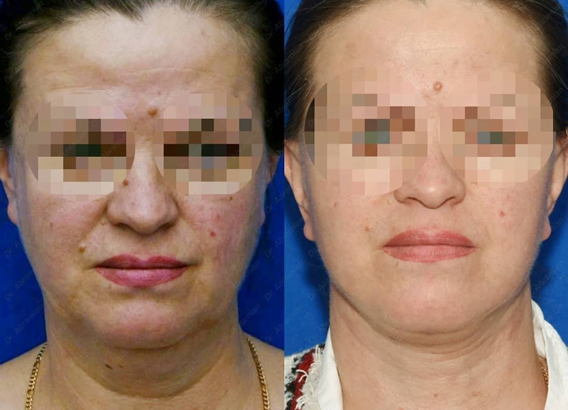 Подтяжка лица и шеи у хирурга Абрамяна С. М., фото до и после