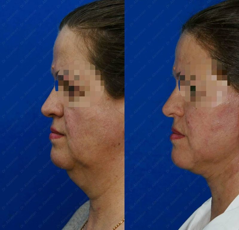 Подтяжка лица и шеи у хирурга Абрамяна С. М., фото до и после