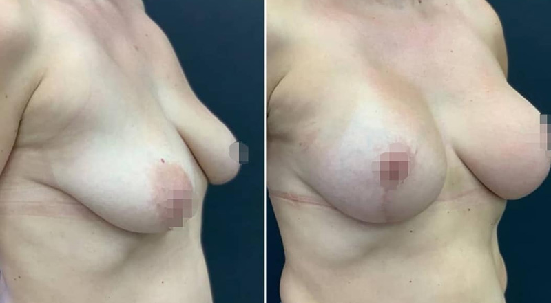 Подтяжки груди с имплантами, фото до и после