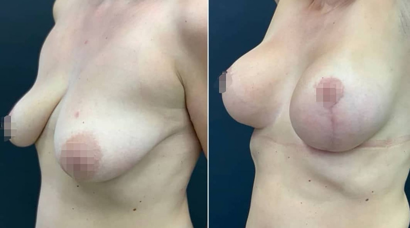 Подтяжки груди с имплантами, фото до и после