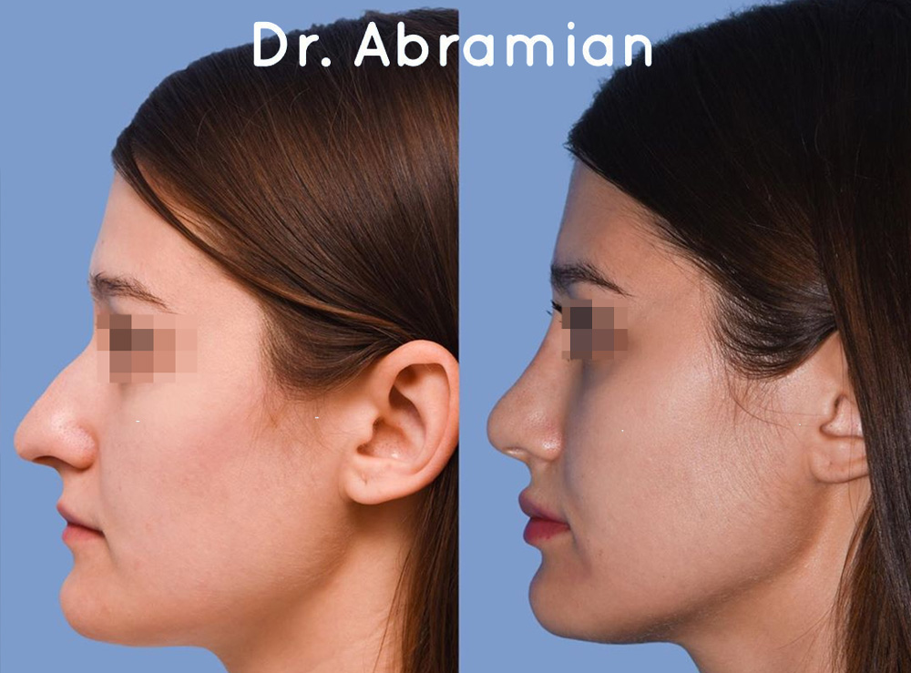 Ринопластика у доктора Абрамяна, фото до и после