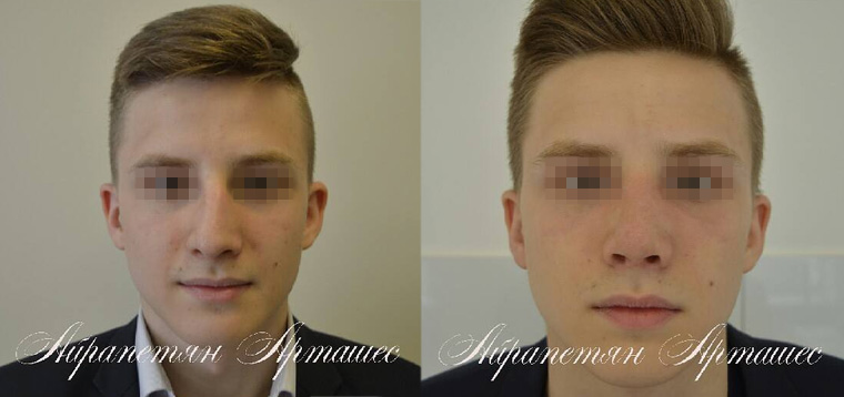 Риносептопластика при посттравматической деформации носа, фото до и после