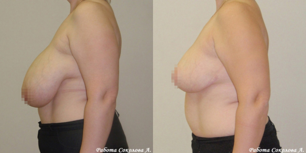 Уменьшение груди до третьего размера у хирурга Соколова А. А. фото до и после