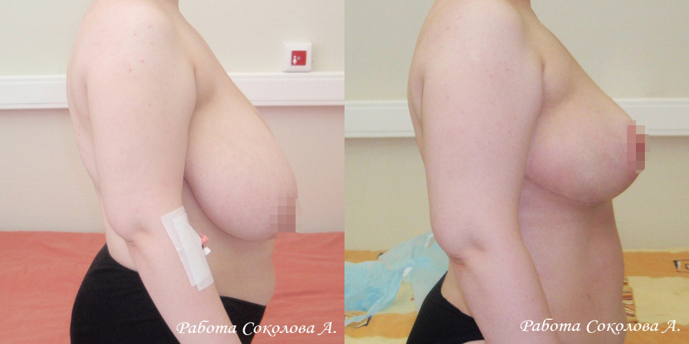 Уменьшение груди с 10 размера до 4, фото до и после