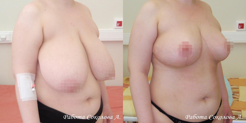 Уменьшение груди с 10 размера до 4, фото до и после