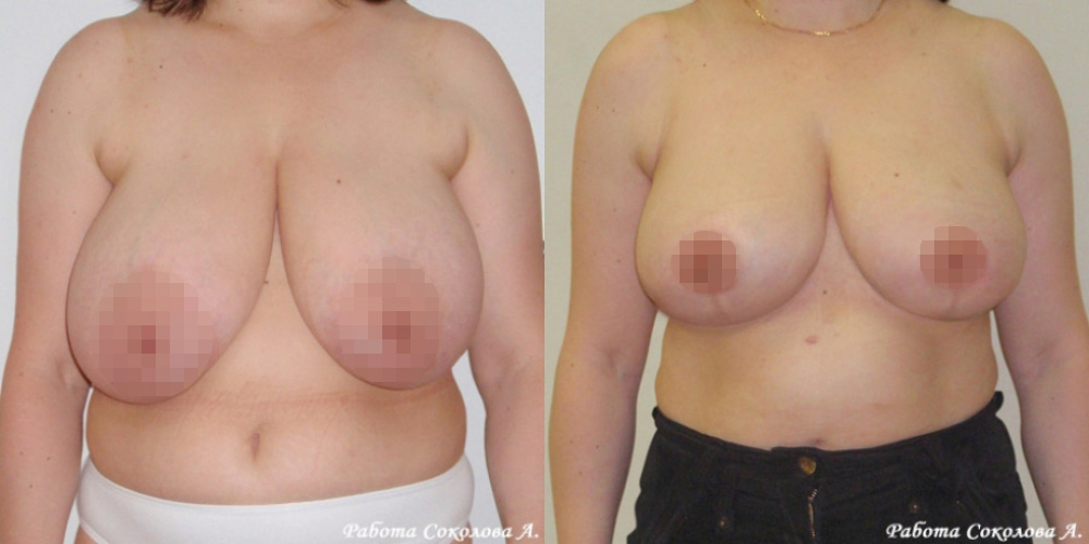 Уменьшение груди с 8 до 4 размера, фото до и после
