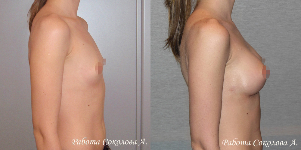Увеличение груди анатомическими имплантатами объемом 190 куб. см., фото до и после