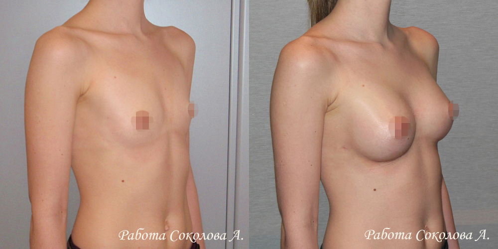Увеличение груди анатомическими имплантатами объемом 190 куб. см., фото до и после