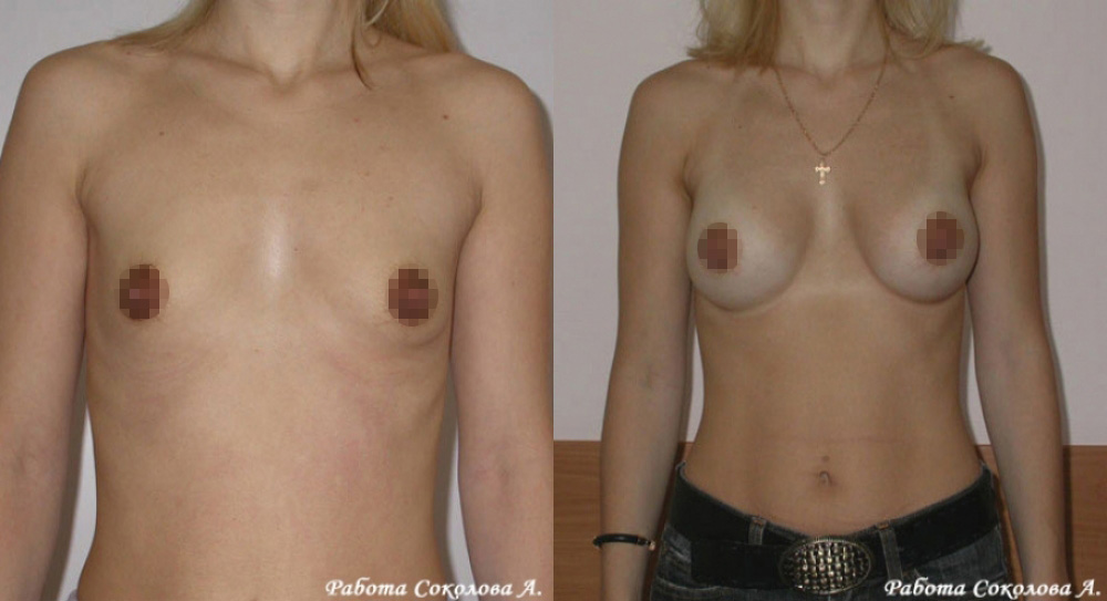 Увеличение груди через периареолярный доступ, фото до и после