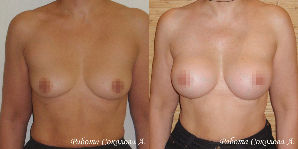 Увеличение груди через подгрудный доступ, фото до и после