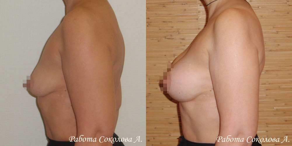 Увеличение груди через подгрудный доступ, фото до и после