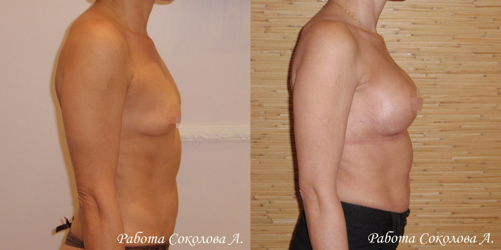 Увеличение груди через субмаммарный доступ, фото до и после