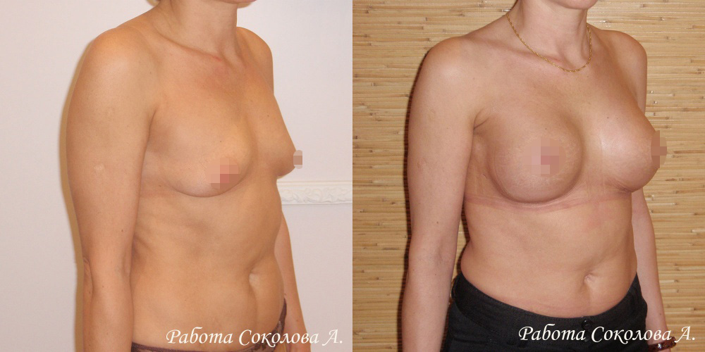 Увеличение груди через субмаммарный доступ, фото до и после