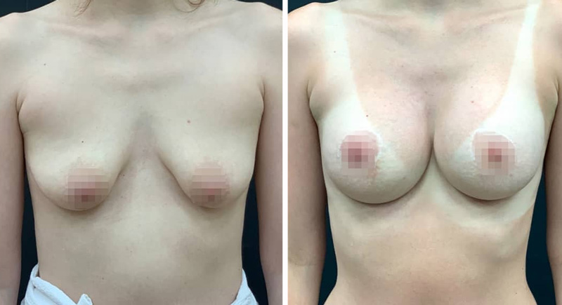 Увеличение груди имплантами с периареолярной подтяжкой, фото до и после