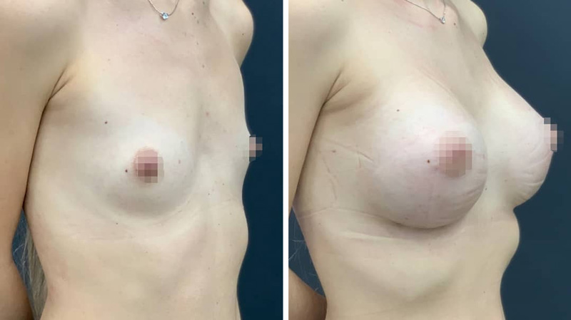 Увеличение груди круглыми текстурированными имплантами, фото до и после