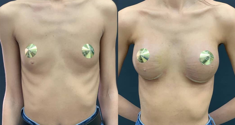 Увеличение груди полиуретановыми имплантами, фото до и после