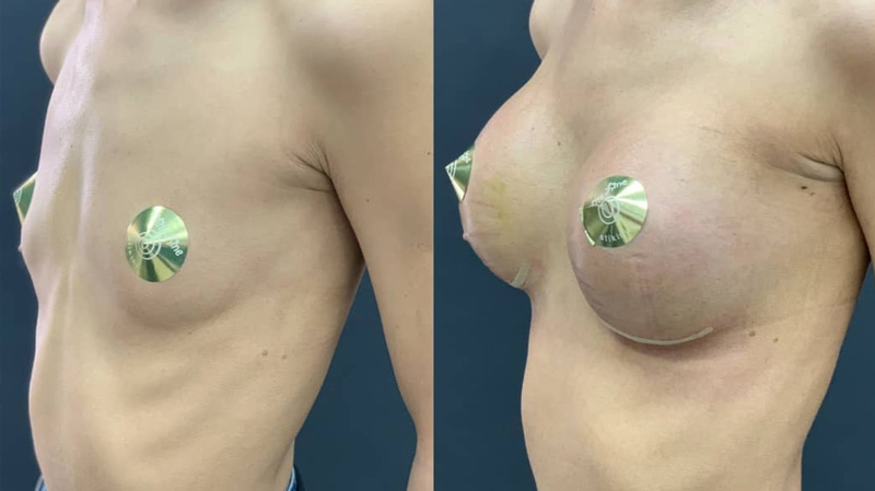 Увеличение груди полиуретановыми имплантами, фото до и после