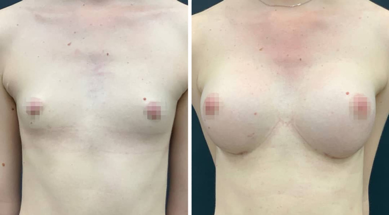 Увеличение груди с нулевого до третьего размера, фото до и после