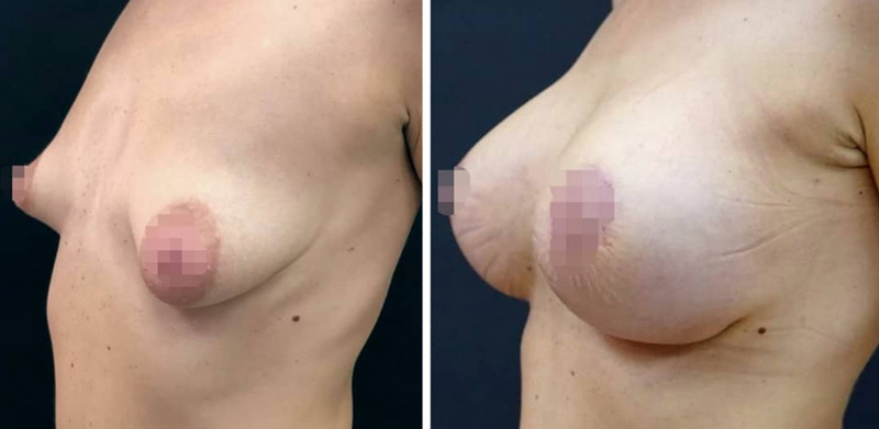 Увеличение тубулярной груди, фото до и после