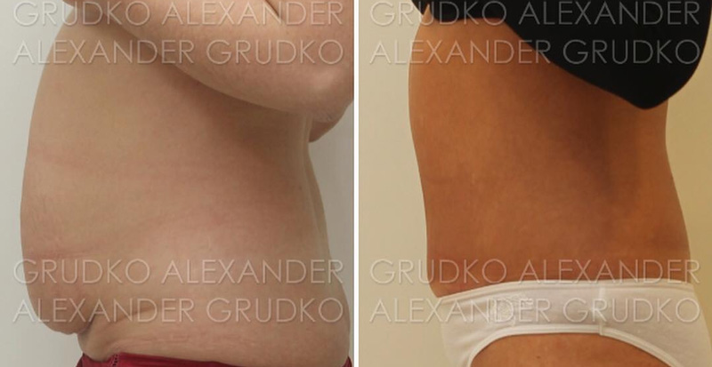Абдоминопластика у пластического хирурга Грудько А. В., фото до и после