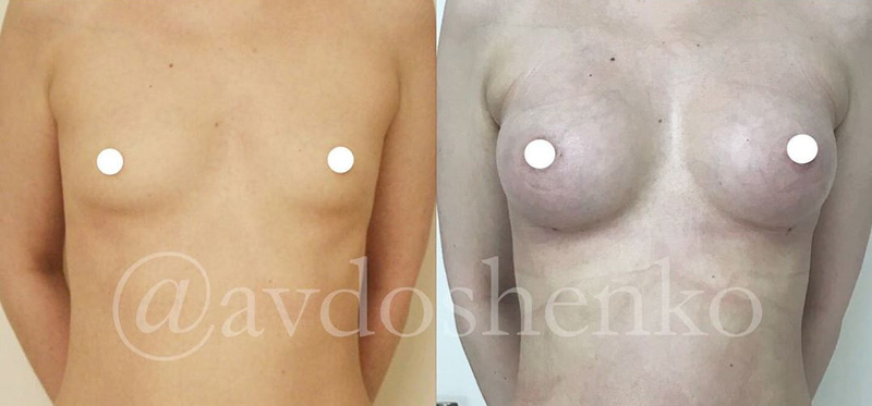 Эндоскопическое увеличение груди, фото до и после