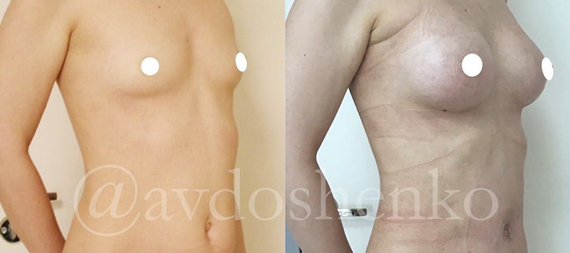 Эндоскопическое увеличение груди, фото до и после