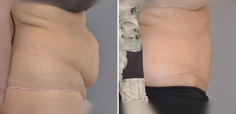 Классическая абдоминопластика с переносом пупка, фото до и после