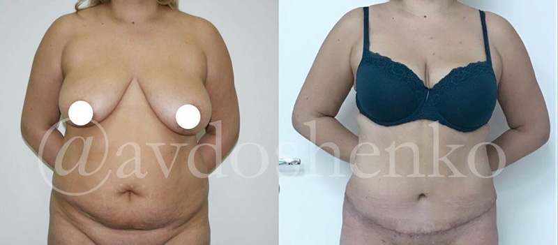 Классическая абдоминопластика с переносом пупка и липосакция, фото до и после
