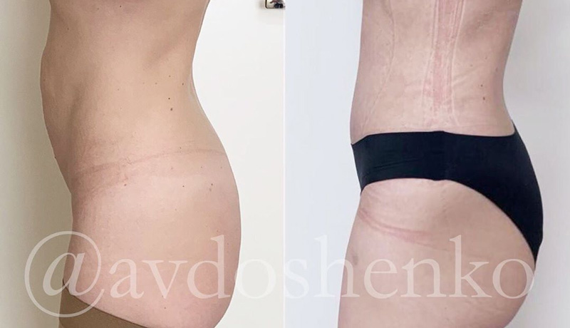 Классическая абдоминопластика с ушиванием диастаза, фото до и после