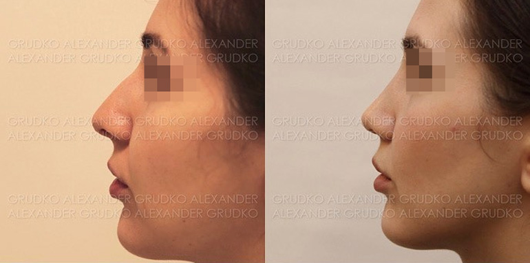 Пластика крыльев носа и уменьшение ноздрей, фото до и после