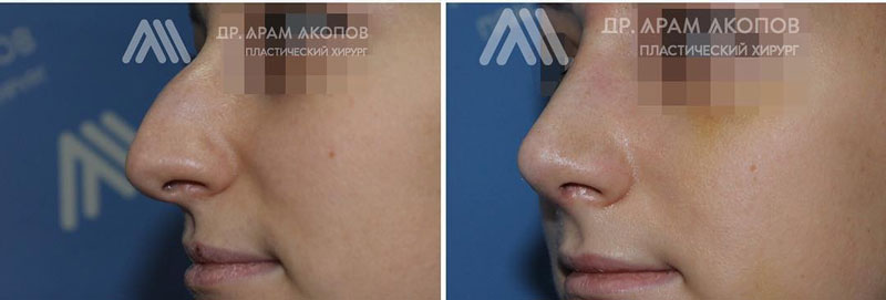 Пластика носа у хирурга Акопова А. А., фото до и после